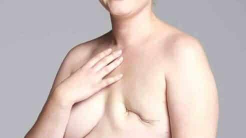 El Supremo niega la indemnización a una mujer que sufrió una mastectomía por el retraso en el diagnóstico de cáncer 
