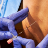 epidural